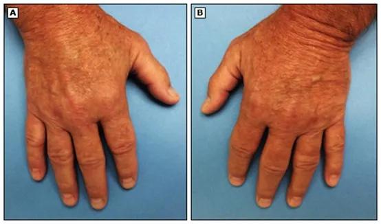 基孔肯雅熱患者會痛一輩子?專家回應